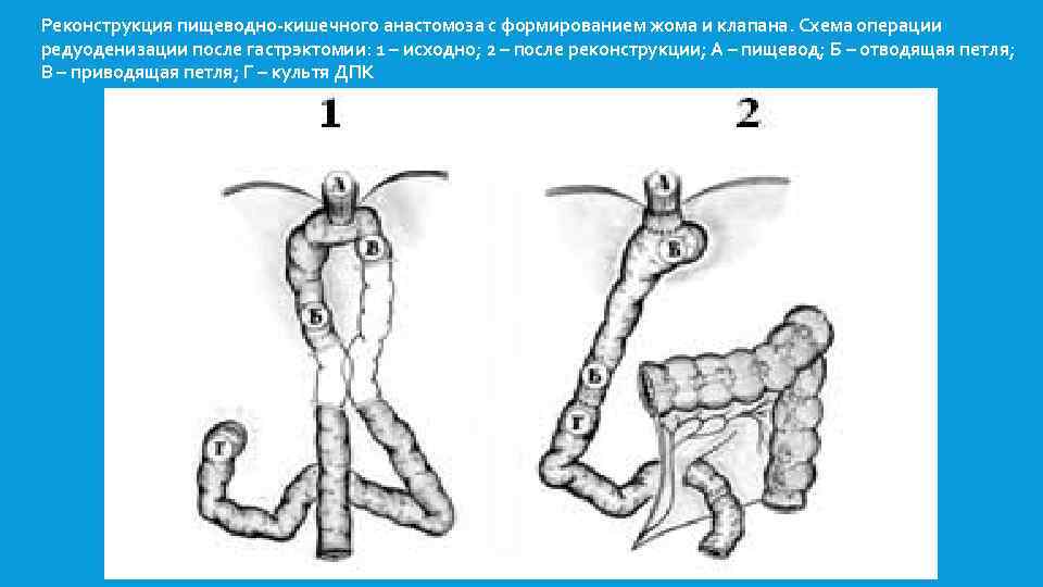 Схема операции. Пищеводно-кишечный анастомоз по Давыдову. Гастрэктомия по Давыдову схема операции. Анастомоз под Давыдову. Гастрэктомия анастомоз по Давыдову.