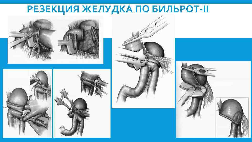 РЕЗЕКЦИЯ ЖЕЛУДКА ПО БИЛЬРОТ-II 