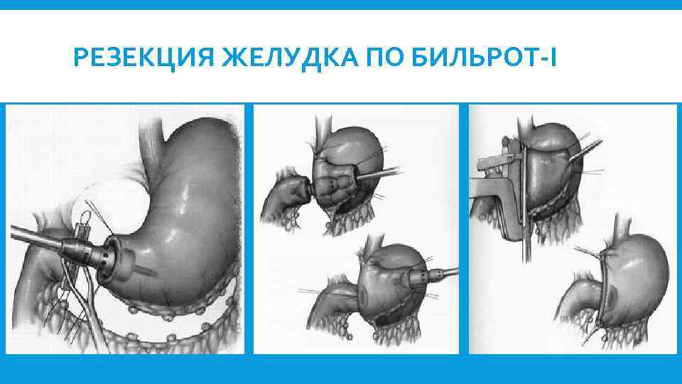 РЕЗЕКЦИЯ ЖЕЛУДКА ПО БИЛЬРОТ-I 