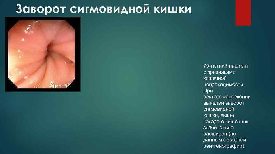Заворот сигмовидной кишки 75 -летний пациент с признаками кишечной непроходимости. При ректороманоскопии выявлен заворот