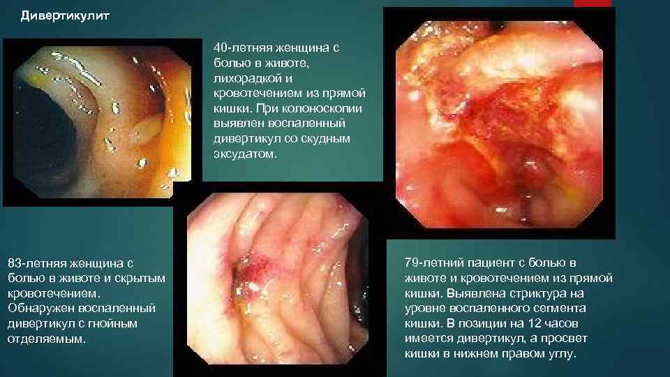 Дивертикулит 40 -летняя женщина с болью в животе, лихорадкой и кровотечением из прямой кишки.