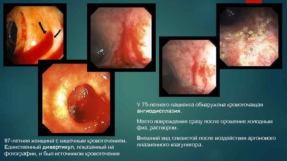 У 75 -летнего пациента обнаружена кровоточащая ангиодисплазия. Место повреждения сразу после орошения холодным физ.
