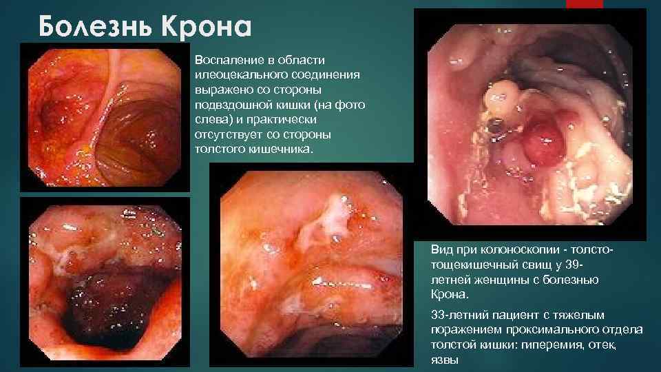 Болезнь Крона Воспаление в области илеоцекального соединения выражено со стороны подвздошной кишки (на фото