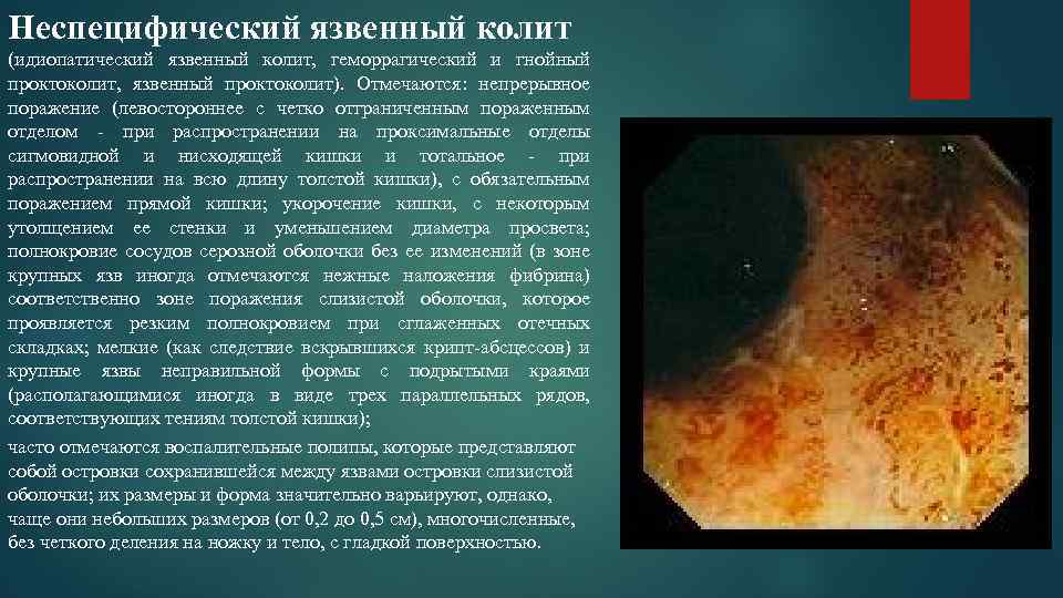 Неспецифический язвенный колит (идиопатический язвенный колит, геморрагический и гнойный проктоколит, язвенный проктоколит). Отмечаются: непрерывное
