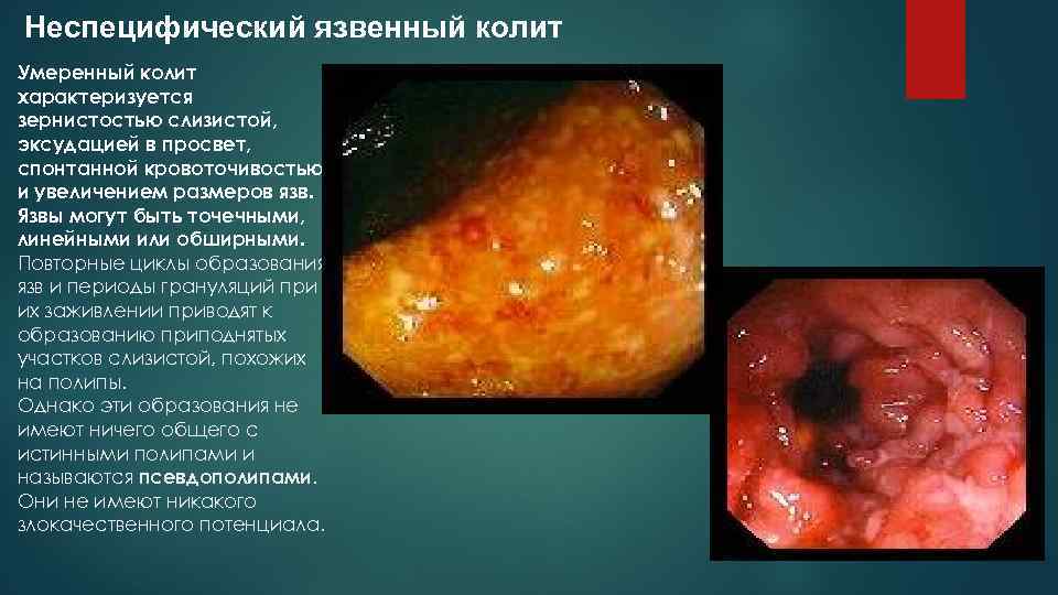 Неспецифический язвенный колит Умеренный колит характеризуется зернистостью слизистой, эксудацией в просвет, спонтанной кровоточивостью и