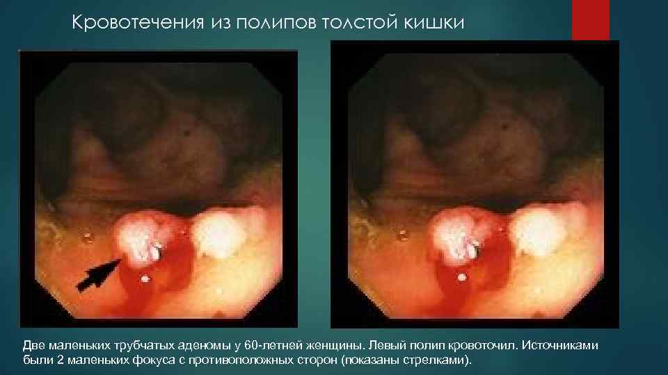 Кровотечения из полипов толстой кишки Две маленьких трубчатых аденомы у 60 -летней женщины. Левый