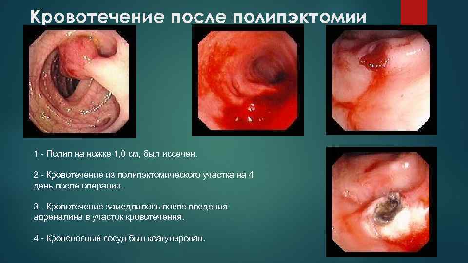 Кровотечение после полипэктомии 1 - Полип на ножке 1, 0 см, был иссечен. 2