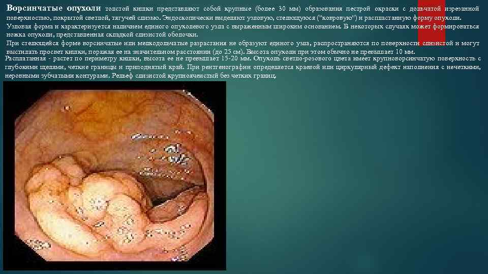 Ворсинчатые опухоли толстой кишки представляют собой крупные (более 30 мм) образования пестрой окраски с