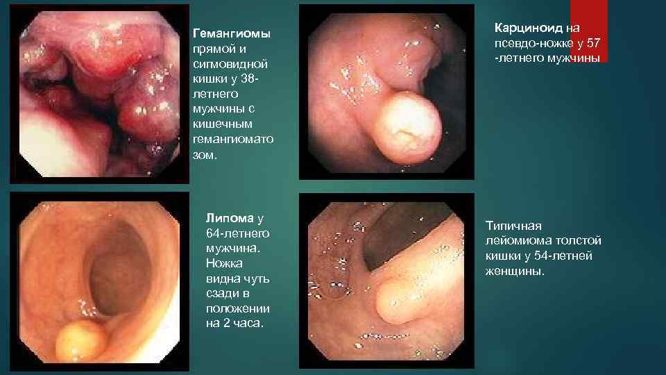 Гемангиомы прямой и сигмовидной кишки у 38 летнего мужчины с кишечным гемангиомато зом. Липома