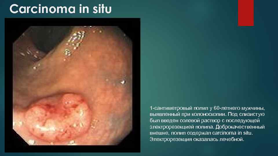 Carcinoma in situ 1 -сантиметровый полип у 60 -летнего мужчины, выявленный при колоноскопии. Под