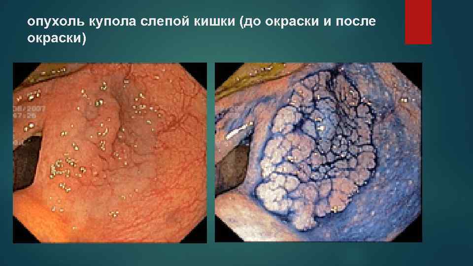 опухоль купола слепой кишки (до окраски и после окраски) 