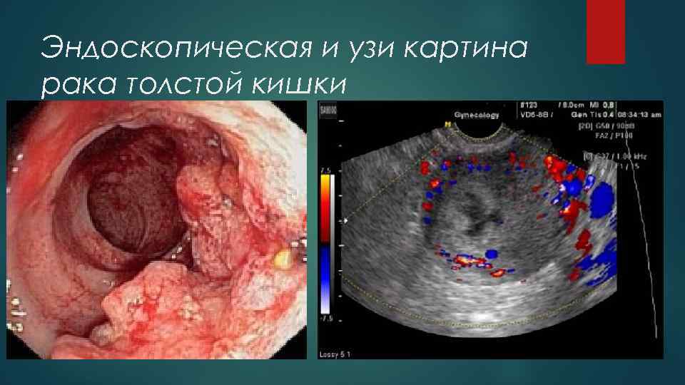 Эндоскопическая и узи картина рака толстой кишки 