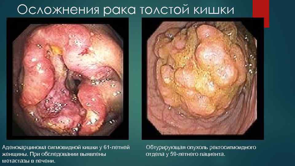 Осложнения рака толстой кишки Аденокарцинома сигмовидной кишки у 61 -летней женщины. При обследовании выявлены