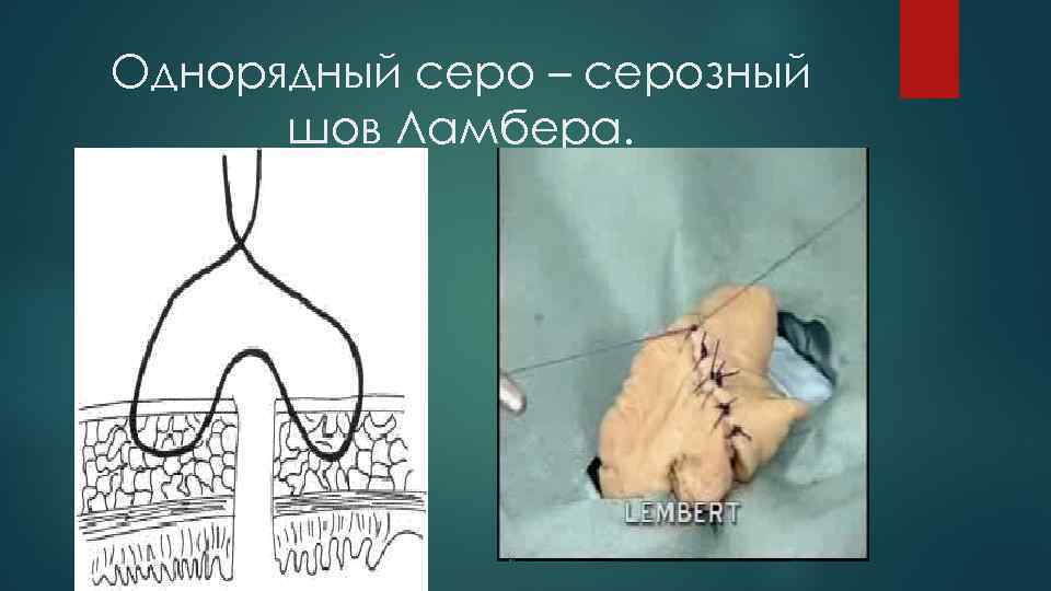 Однорядный серо – серозный шов Ламбера. 