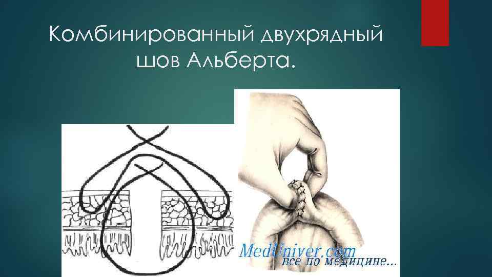 Комбинированный двухрядный шов Альберта. 