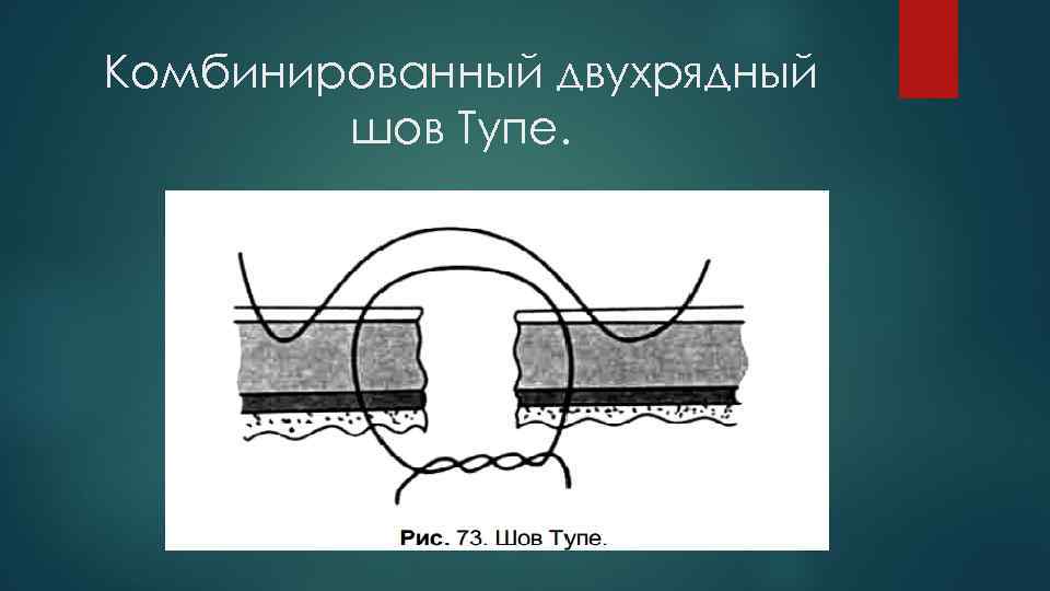 Комбинированный двухрядный шов Тупе. 
