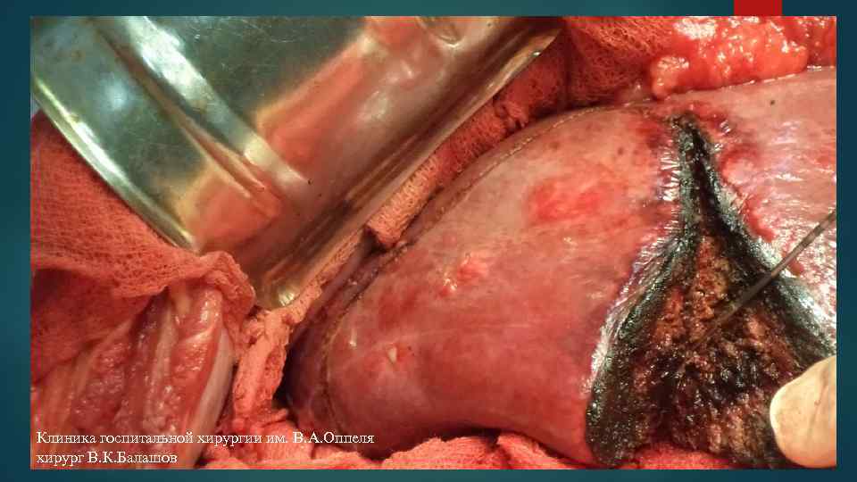 Клиника госпитальной хирургии им. В. А. Оппеля хирург В. К. Балашов 