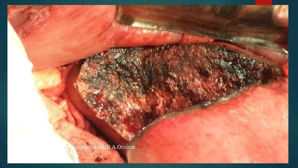 Клиника госпитальной хирургии им. В. А. Оппеля хирург В. К. Балашов 