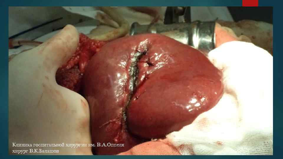 Клиника госпитальной хирургии им. В. А. Оппеля хирург В. К. Балашов 