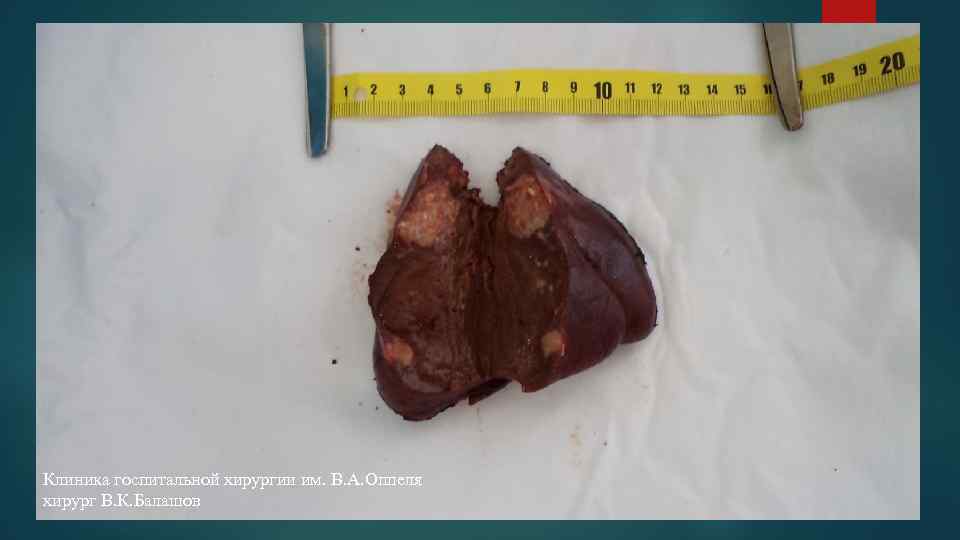Клиника госпитальной хирургии им. В. А. Оппеля хирург В. К. Балашов 