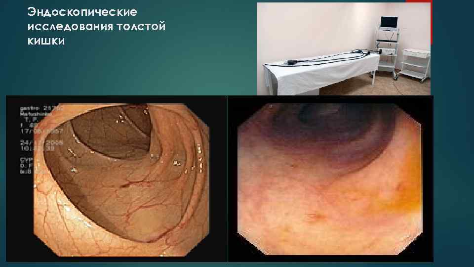 Эндоскопические исследования толстой кишки 