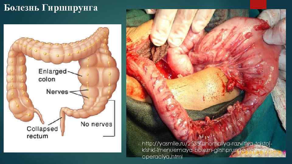 Болезнь Гиршпрунга http: //yasmile. ru/2535 anomaliya razvitiya tolstoj kishki imenuemaya bolezn girshprunga slozhnaya operaciya.