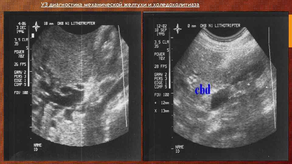 УЗ диагностика механической желтухи и холедохолитиаза 