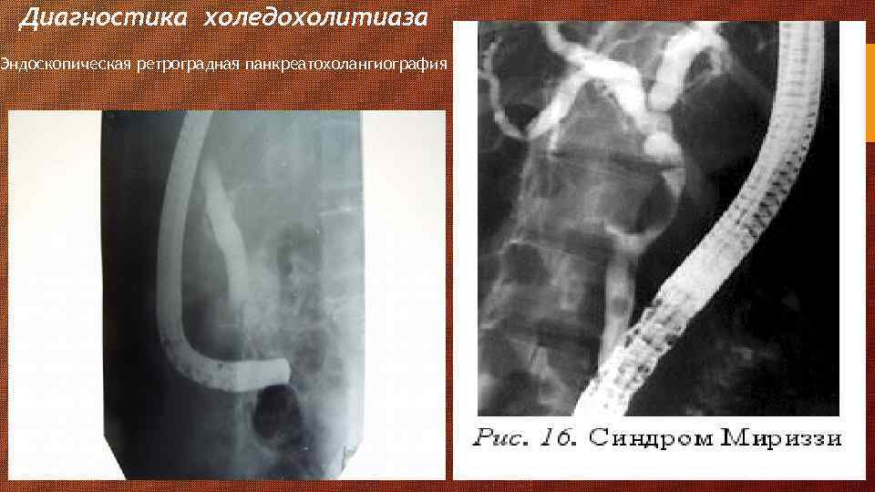 Диагностика холедохолитиаза Эндоскопическая ретроградная панкреатохолангиография 