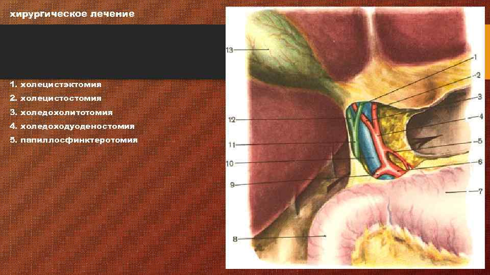 хирургическое лечение 1. холецистэктомия 2. холецистостомия 3. холедохолитотомия 4. холедоходуоденостомия 5. папиллосфинктеротомия 