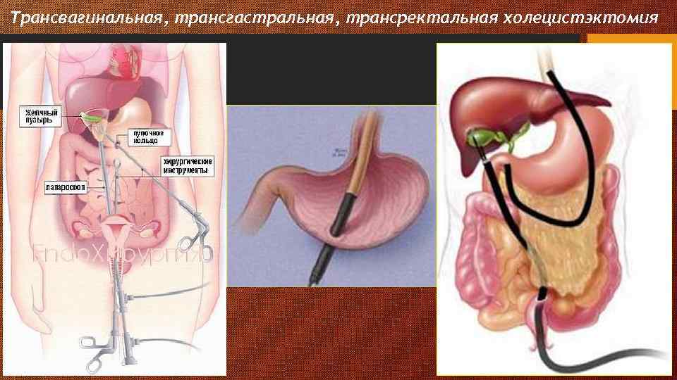 Трансвагинальная, трансгастральная, трансректальная холецистэктомия 