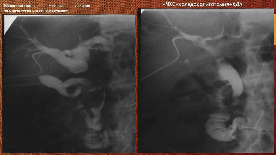 Малоинвазивные методы холедохолитиаза и его осложнений лечения ЧЧХС+холедохолитотомия+ХДА 