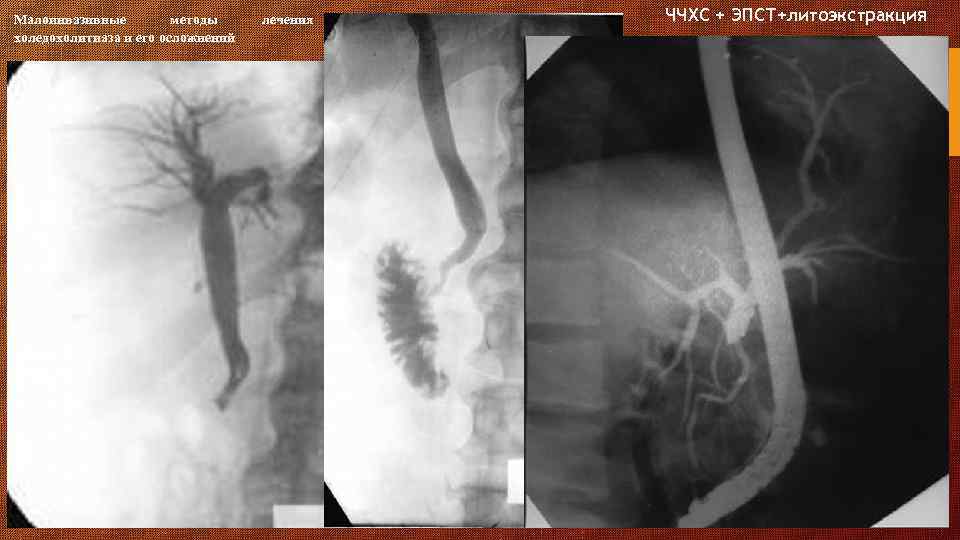 Малоинвазивные методы холедохолитиаза и его осложнений лечения ЧЧХС + ЭПСТ+литоэкстракция 