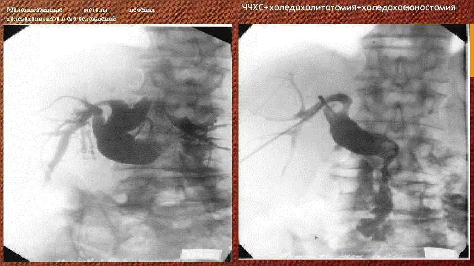 Малоинвазивные методы холедохолитиаза и его осложнений лечения ЧЧХС+холедохолитотомия+холедохоеюностомия 