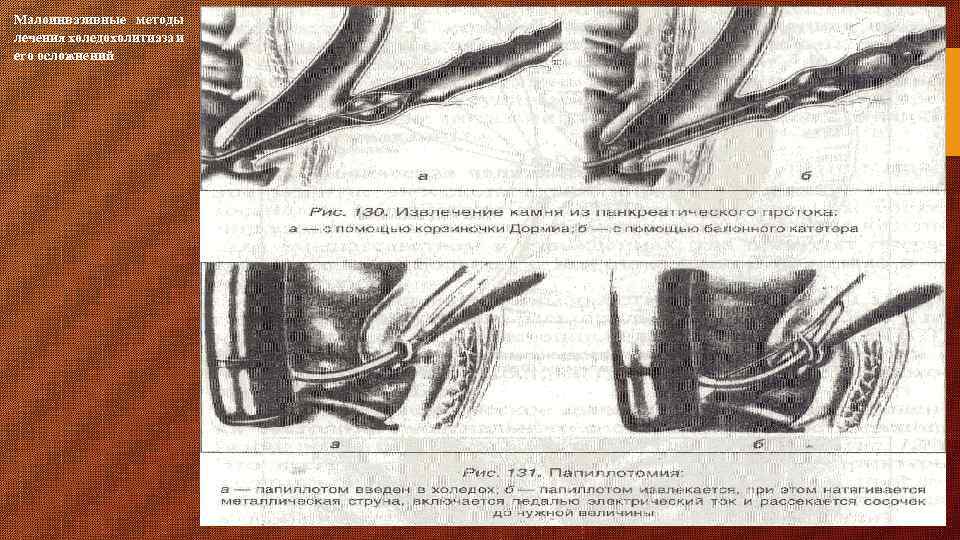 Малоинвазивные методы лечения холедохолитиаза и его осложнений 