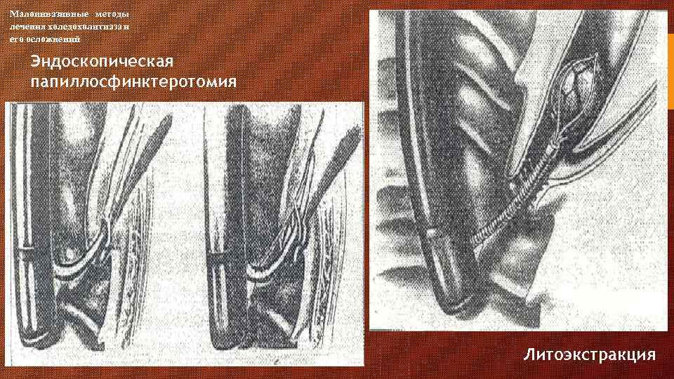 Малоинвазивные методы лечения холедохолитиаза и его осложнений Эндоскопическая папиллосфинктеротомия Литоэкстракция 