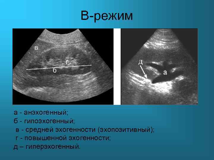 B-режим а - анэхогенный; б - гипоэхогенный; в - средней эхогенности (эхопозитивный); г -