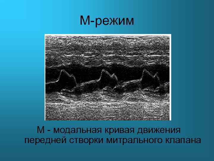 M-режим М - модальная кривая движения передней створки митрального клапана 