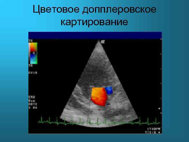 Цветовое допплеровское картирование 