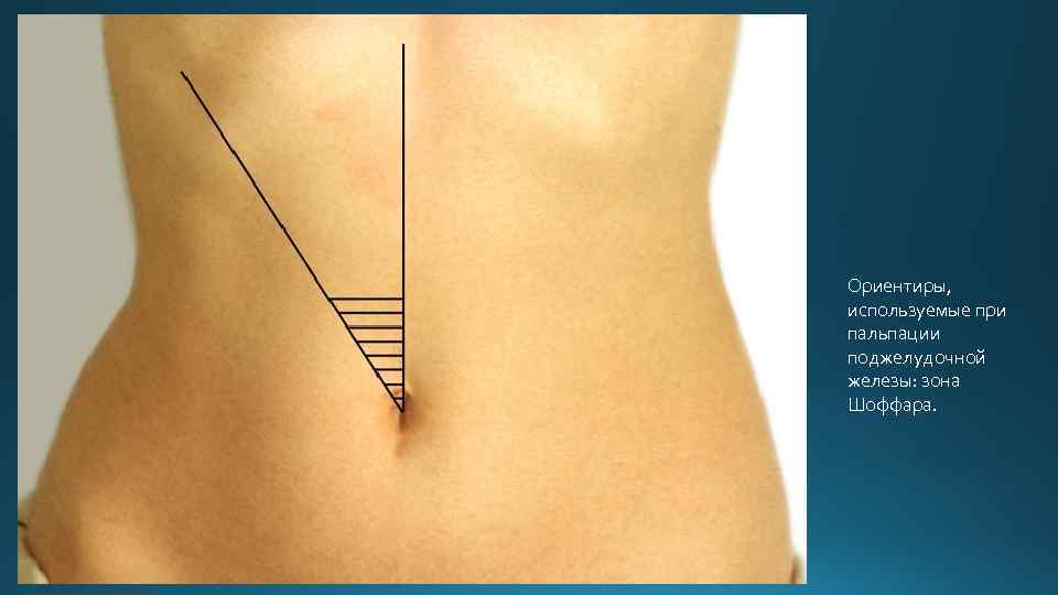 Ориентиры, используемые при пальпации поджелудочной железы: зона Шоффара. 