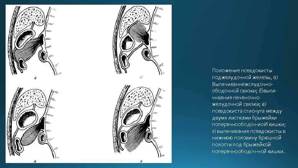 Положение псевдокисты поджелудочной железы, а) Выпячиваннежслудочноободочной связки; б)выпячнвание печеночножелудочной связки; в) псевдокиста стиснута между