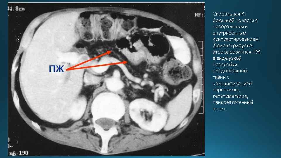 Спиральная КТ брюшной полости с пероральным и внутривенным контрастированием. Демонстрируется атрофированная ПЖ в виде