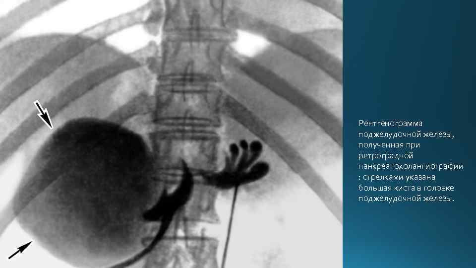 Рентгенограмма поджелудочной железы, полученная при ретроградной панкреатохолангиографии : стрелками указана большая киста в головке