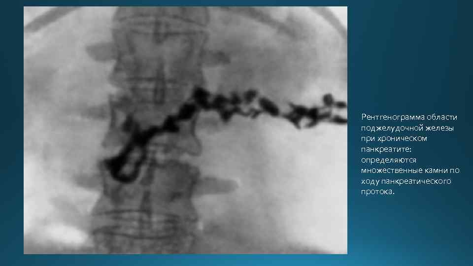 Рентгенограмма области поджелудочной железы при хроническом панкреатите: определяются множественные камни по ходу панкреатического протока.