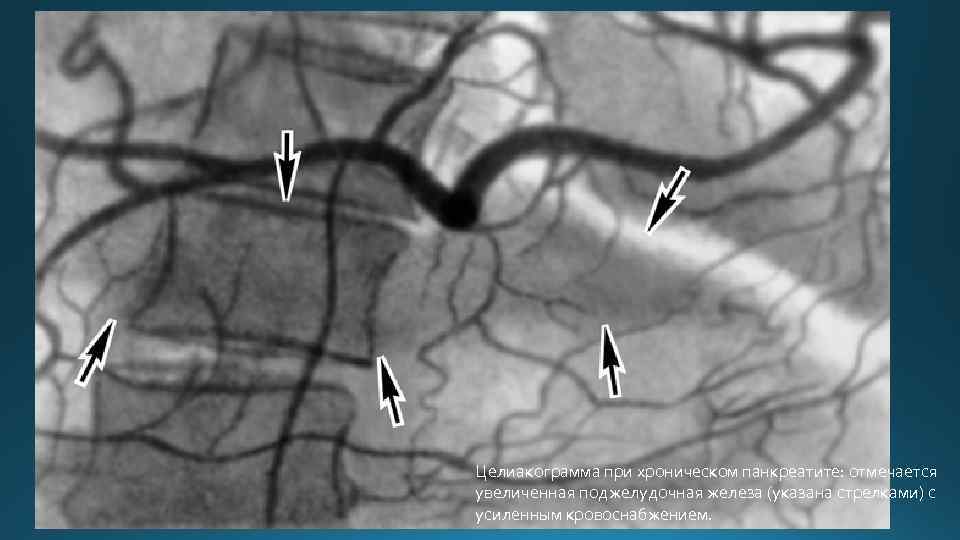 Целиакограмма при хроническом панкреатите: отмечается увеличенная поджелудочная железа (указана стрелками) с усиленным кровоснабжением. 