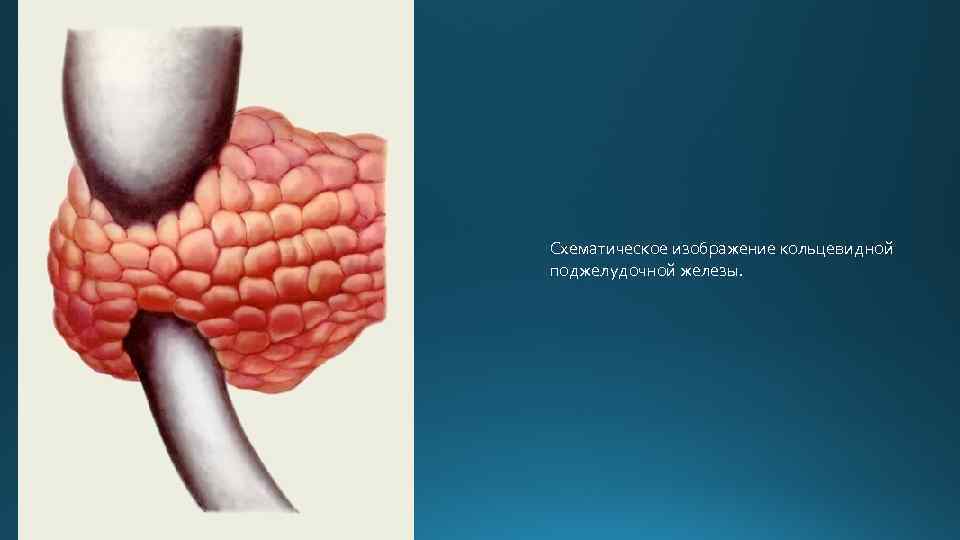 Схематическое изображение кольцевидной поджелудочной железы. 