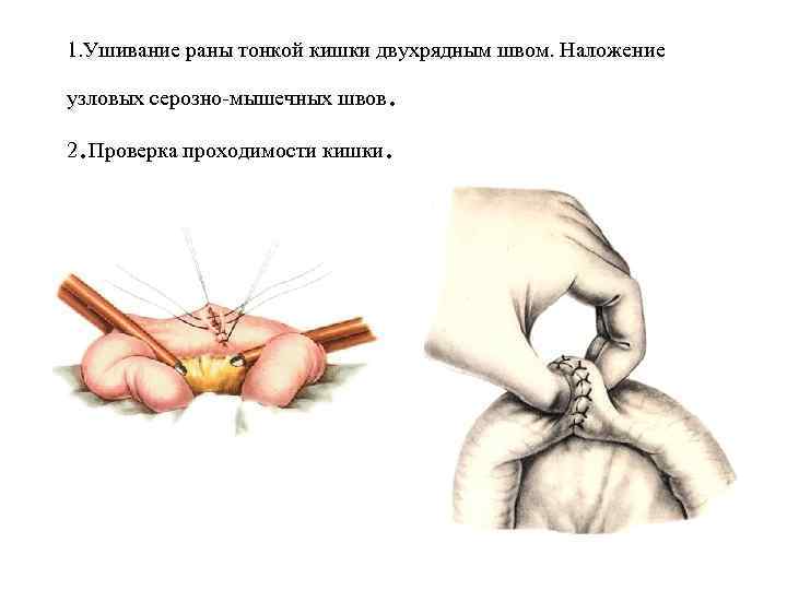 1. Ушивание раны тонкой кишки двухрядным швом. Наложение . 2. Проверка проходимости кишки. узловых