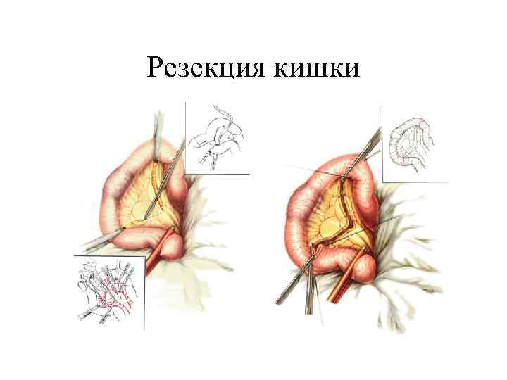 Резекция кишки 