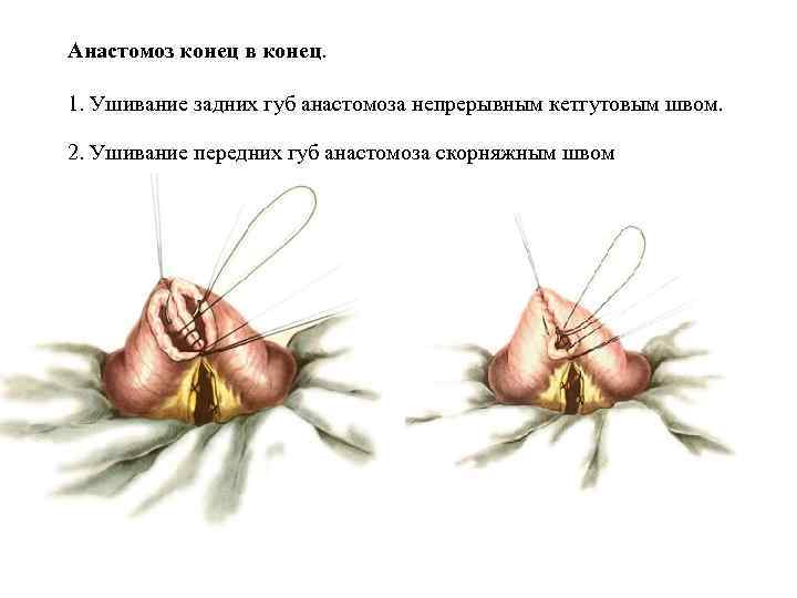 Анастомоз конец в конец. 1. Ушивание задних губ анастомоза непрерывным кетгутовым швом. 2. Ушивание