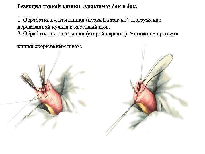 Резекция тонкой кишки. Анастомоз бок в бок. 1. Обработка культи кишки (первый вариант). Погружение