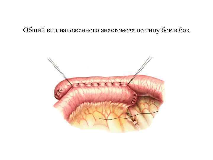 Общий вид наложенного анастомоза по типу бок в бок 